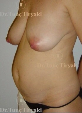 Before Breast Reduction | Gallery Image 3