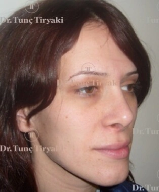 Before Fat Transfer to the Face | Gallery Image 2