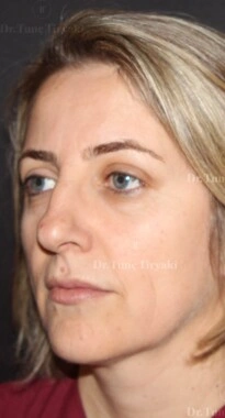 Before Facial Stem Cell Treatment | Gallery Image 18