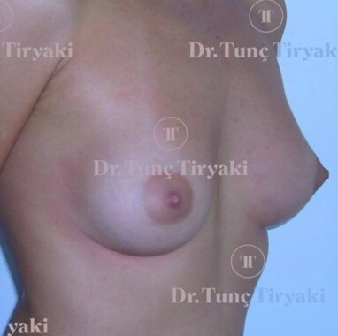 After Breast Augmentation | Gallery Image 1