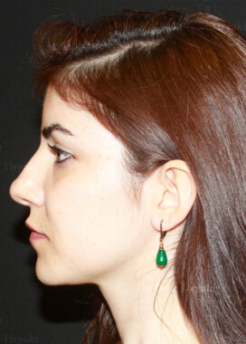 After Facial Stem Cell Treatment | Gallery Image 8