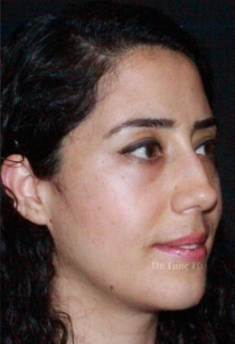 After Facial Stem Cell Treatment | Gallery Image 20