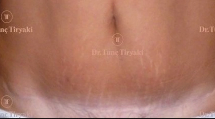 After Endoscopic Tummy Tuck | Gallery Image 2