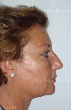 After Micro-Facelift | Gallery Image 5