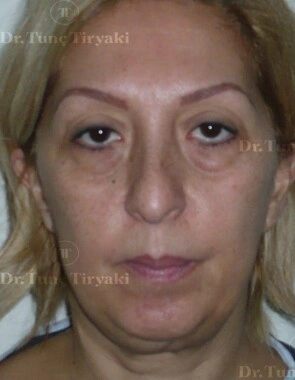 Before Fat Transfer to the Face | Gallery Image 11