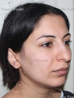 Before Fat Transfer to the Face | Gallery Image 6