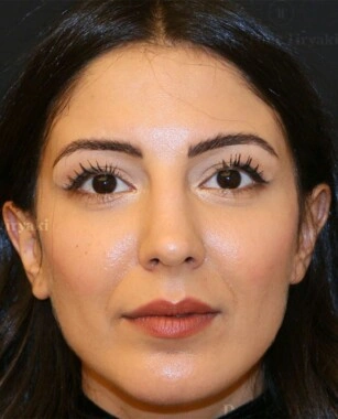 After Fat Transfer to the Face | Gallery Image 4