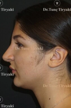 After Rhinoplasty | Gallery Image 4