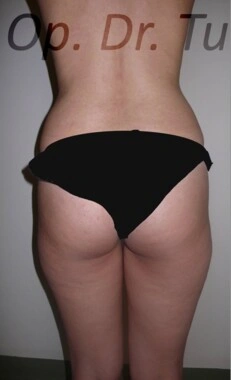 Before Liposuction | Gallery Image 2
