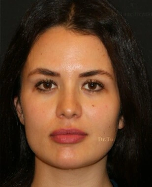 After Facial Stem Cell Treatment | Gallery Image 11