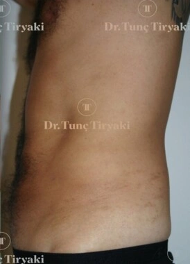 After Tummy Tuck | Gallery Image 1
