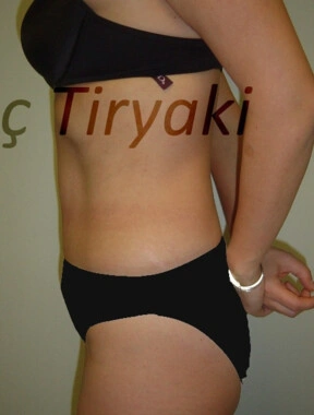 After Tummy Tuck | Gallery Image 4