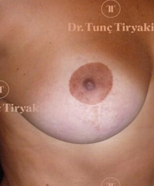 After Breast Reduction | Gallery Image 4