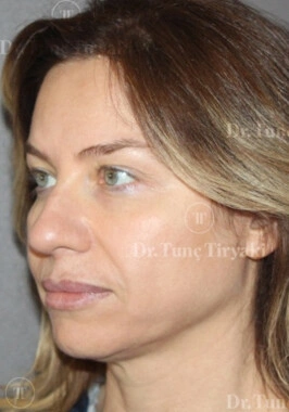 Before Facial Stem Cell Treatment | Gallery Image 24