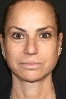 After Nano Facelift | Gallery Image 1