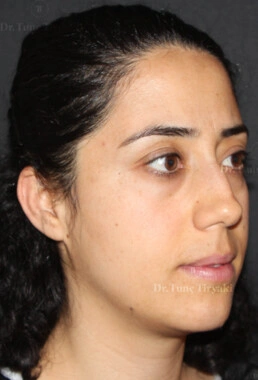 Before Facial Stem Cell Treatment | Gallery Image 20