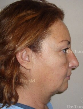 Before Micro-Facelift | Gallery Image 5