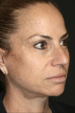 After Nano Facelift | Gallery Image 2