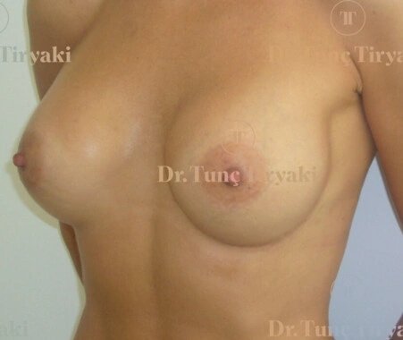 After Breast Augmentation | Gallery Image 2