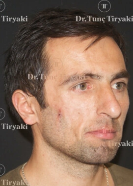 After Facial Stem Cell Treatment | Gallery Image 2
