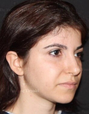 Before Facial Stem Cell Treatment | Gallery Image 9