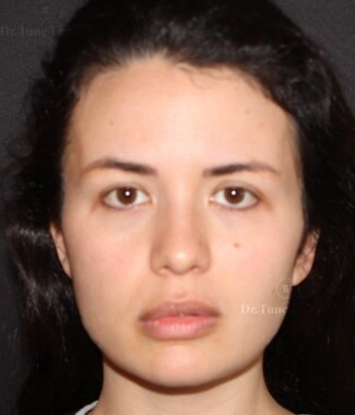 Before Facial Stem Cell Treatment | Gallery Image 11