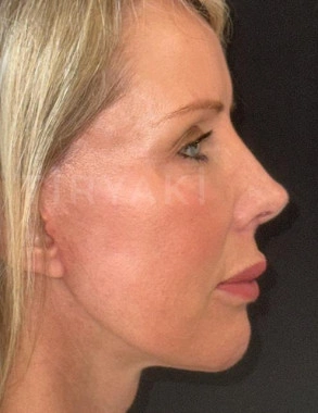 After Facial Stem Cell Treatment | Gallery Image 28