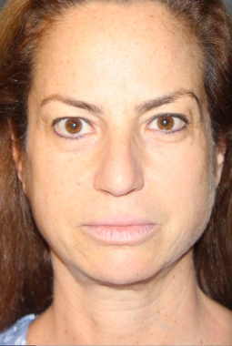 Before Nano Facelift | Gallery Image 1
