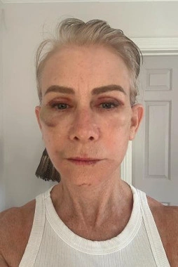 Recovery Week 1