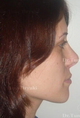 Before Fat Transfer to the Face | Gallery Image 3