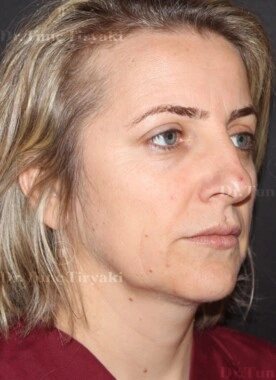 Before Facial Stem Cell Treatment | Gallery Image 17