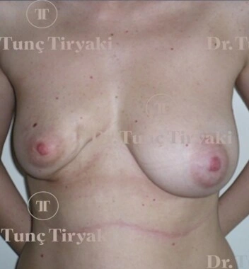 Before Breast Reconstruction | Gallery Image 1