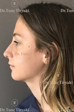 Before Nose Tip Plasty | Gallery Image 1