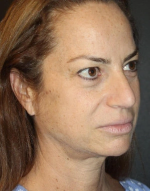 Before Nano Facelift | Gallery Image 2