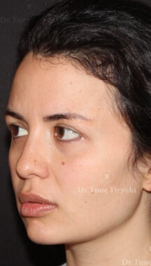 Before Facial Stem Cell Treatment | Gallery Image 10