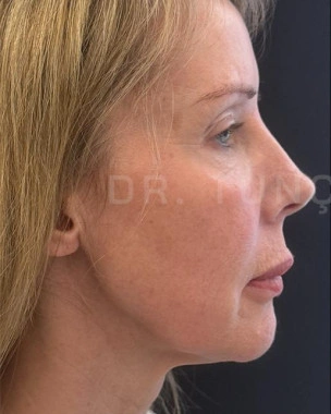 Before Hybrid Deep Plane Facelift | Gallery Image 1