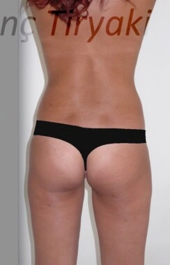 After Liposuction | Gallery Image 2