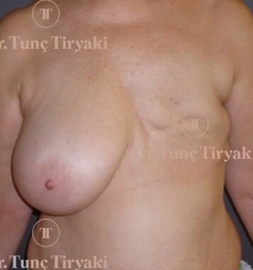 Before Breast Reconstruction | Gallery Image 2