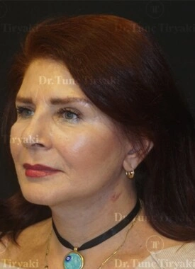 After Neck Lift | Gallery Image 1