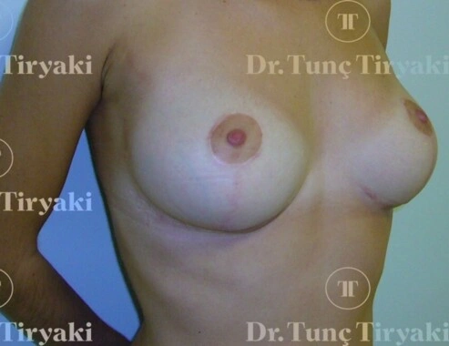 After Breast Lift | Gallery Image 2