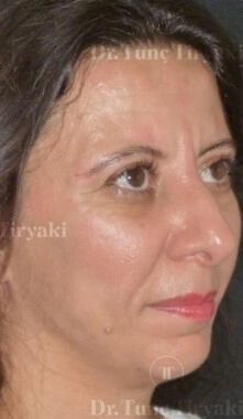 After Fat Transfer to the Face | Gallery Image 7