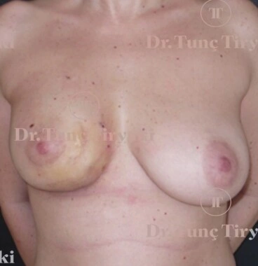After Breast Reconstruction | Gallery Image 1