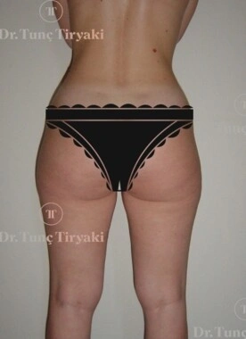 Before Liposuction | Gallery Image 3