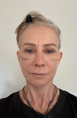 Recovery Week 2