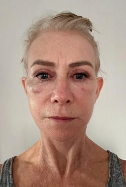 Recovery Week 4