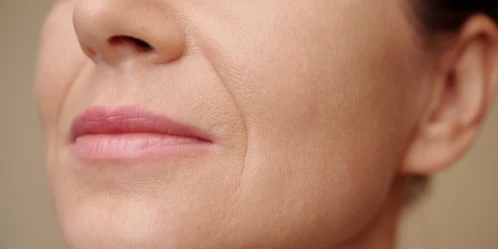 How to Reduce Nasolabial Folds