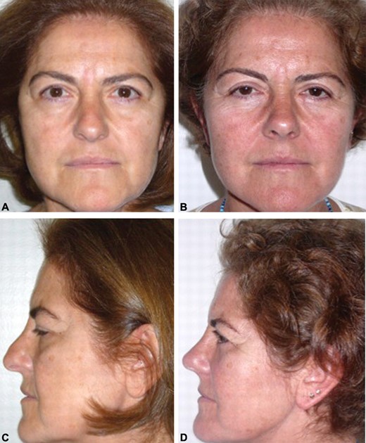 Figure 4 - (A, C) A 58-year-old woman who presented with concerns about facial aging. (B, D) One year after blepharoplasty, as well as neck and midface suspensions, including nasal suspension.