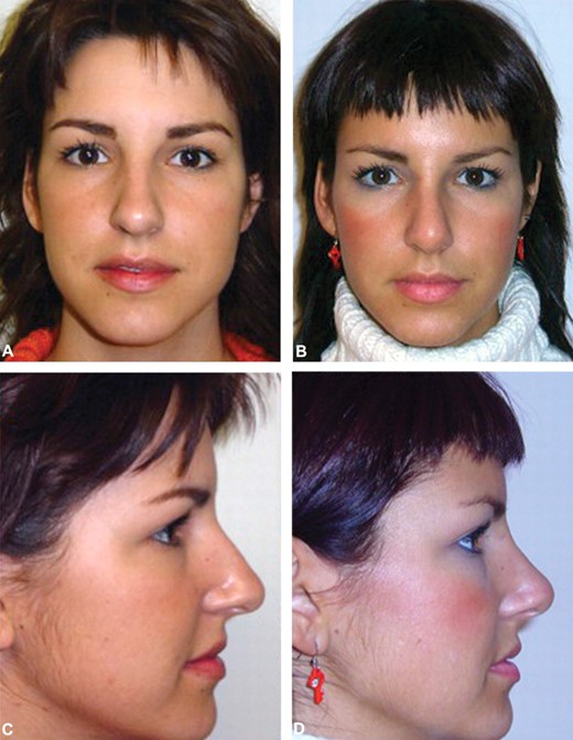 Figure 5 - (A, C) A 26-year-old woman who presented with aesthetic concerns about her nose. (B, D) One year after nasal suspension.