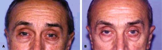 Figure 4 - A, Pretreatment view of a 61-year-old man with brow asymmetry. B, Posttreatment view of eyebrows 2 weeks after Toxin treatments injections.