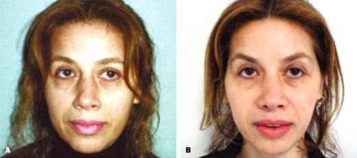 Figure 5 - A, Pretreatment view of a 46-year-old woman with brow asymmetry. B, Posttreatment view of eyebrows 2 weeks after Toxin treatments injection.